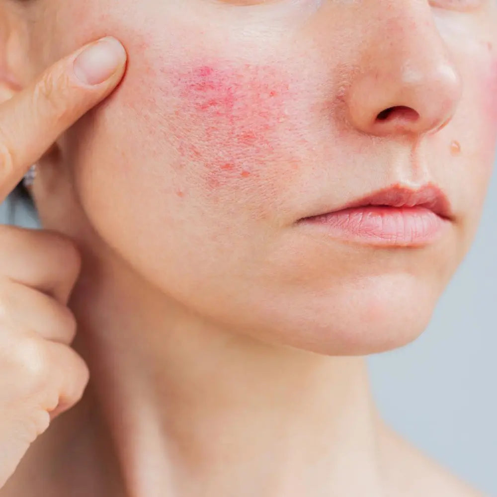 Rutina para piel con Irritación y Rosácea at Casa de Ella Mexico